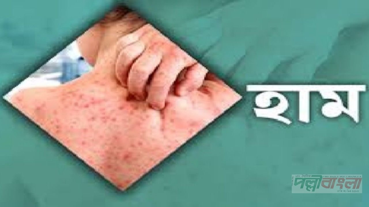 ২৪ ঘণ্টায় হাম উপসর্গে ৩ জনের মৃত্যু